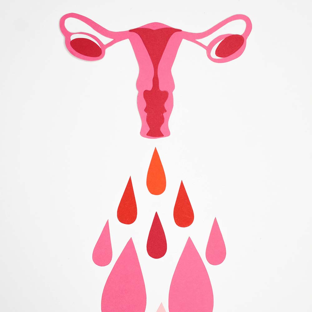 PCOS: Polycystic Ovary Syndrome